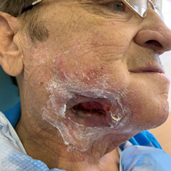 Wounds Post Treatment
