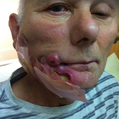 Wounds Post Treatment